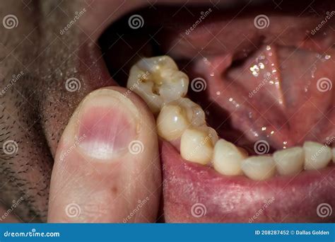 Man`s Open Mouth With Cavity Holes On A Molar Tooth Stock Photo Image