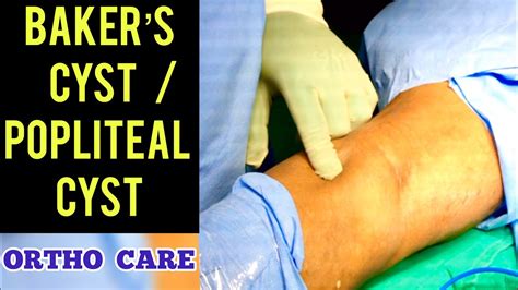Baker S Cyst Popliteal Cyst Excision Bump On Back Of Knee Physio Andtreatment What You Need To