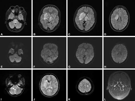 Mri Brain Axial Flair Images A D Show Asymmetrical Right Left