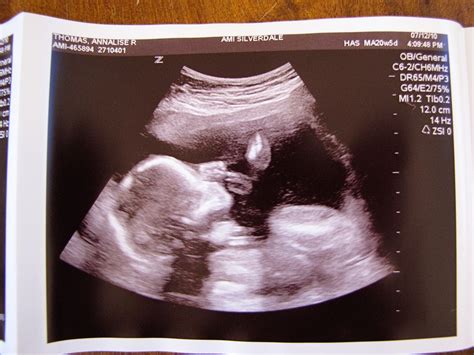 Baby Boy 2s 20 Weeks Ultrasound Sweet Annas