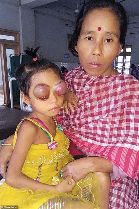 Girl 7 Blinded By Bleeding And Swollen Eyes Makes Miraculous Recovery