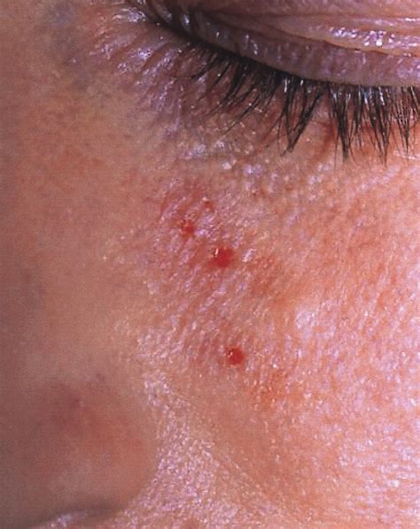 Adults With Atopic Dermatitis And Herpes Simplex And Topical Therapy