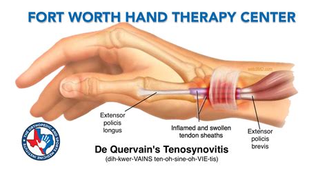 De Quervains Tenosynovitis Chronic Overuse And Strain On The Wrist