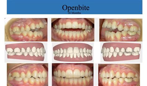 Try moving a few muscles around your face, mouth, eyebrows, eyes, jaw, ext. How do Braces Affect Your Face?