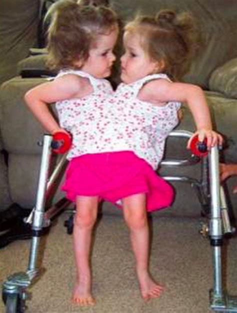 The Conjoined Herrin Twins Their Miraculous Story And What They Look