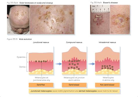 Chart Of Skin Lesions