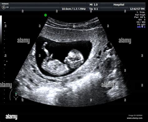 12 Twelve Week Ultrasound Scan Antenatal Photo Of Unborn Foetus Baby In