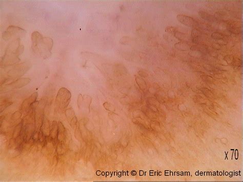 Dermoscopy Dermatofibroma