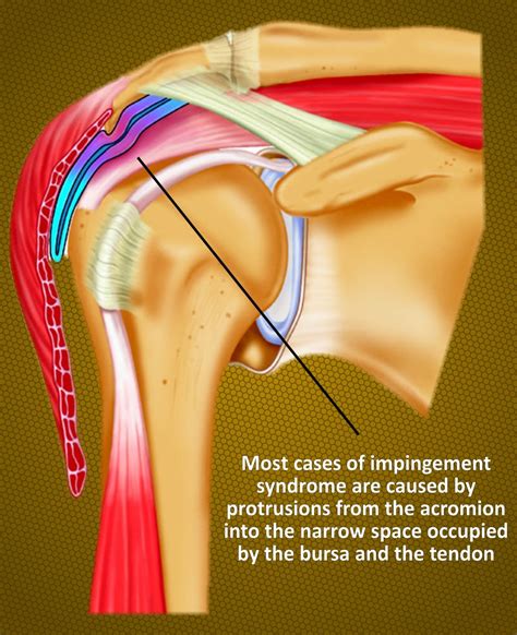 Impingement Syndrome Back In Action