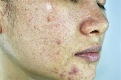 Skin Problem With Acne Diseases Close Up Woman Face With Whitehead
