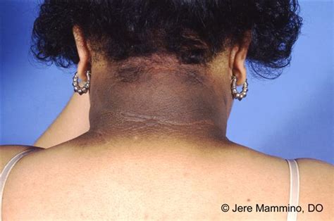 Acanthosis Nigricans American Osteopathic College Of Dermatology Aocd