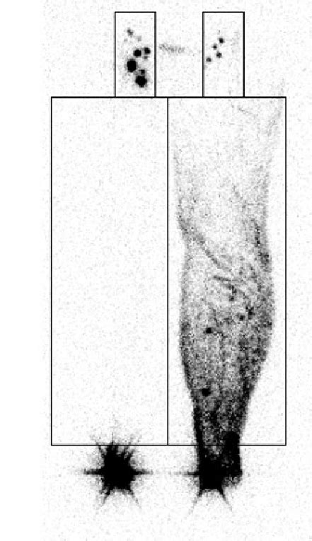 Lymphoscintigraphy Of Left Leg Lymphedema Dermal Backflow Is Shown In