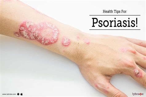 Health Tips For Psoriasis By Dr Ravindranath Reddy Lybrate