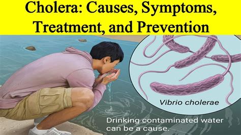 Cholera Causes Symptoms Treatment And Prevention Salmans Speaks