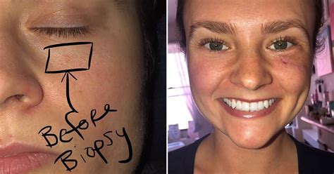 Womans Small Pimple Under Her Eye Turned Out To Be Skin Cancer Small