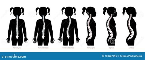Spinal Deformity Types Diseases Of The Spinelordosis Kyphosis Round