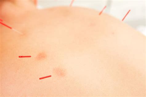 Back Acupuncture Oliver Chiropractic Wellness Clinic