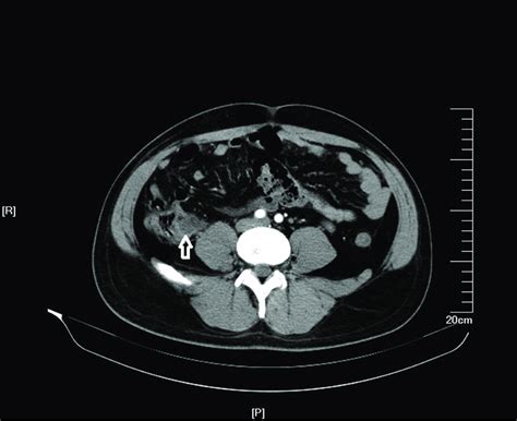 Abdominal Contrast Enhancement Ct Scan Shows An Abscess Lesion Of