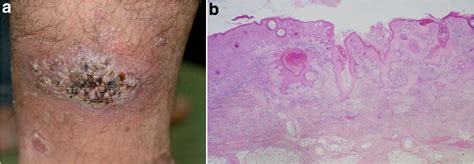 Pdf Rapid Progression Of Hidradenitis Suppurativa In The Lower Leg Of