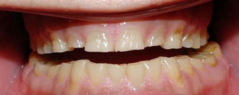 Bruksizm zgrzytanie zębami metody leczenia Dr Mleczak Stomatologia