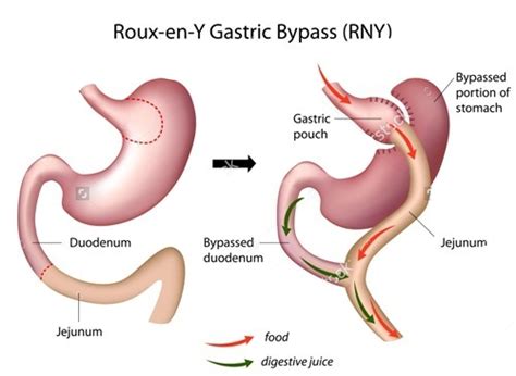 Roux En Y Gastric Bypass Dr Amit Garg
