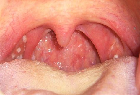 White Spot On Tonsil Medical Point