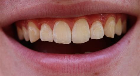 Our Guide To White Spots On Teeth Smile Stories