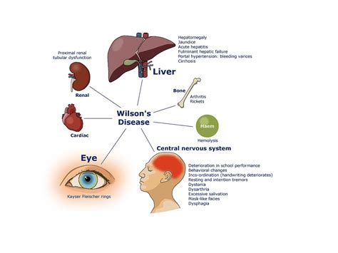 Wilsons Disease Science Biology Genetics Showme