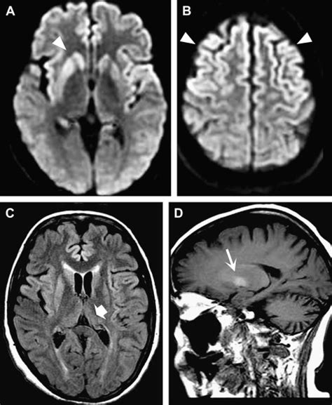 Prion Infections Of The Brain Radiology Key