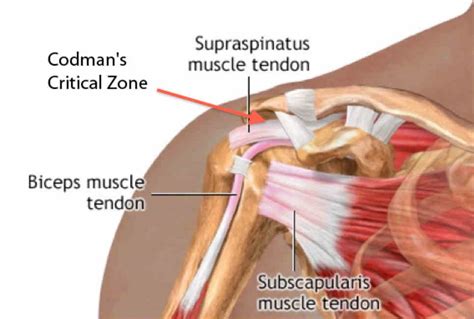 Critical Zone And Supraspinatus Muscle Tendon Massage Methodology