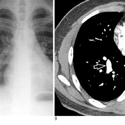 Pdf Pulmonary Vein Varix A Case Report