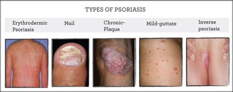 Types Of Psoriasis And Its Triggers And Symptoms You Must Know