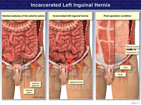Signs Of Inguinal Hernia Hot Sex Picture