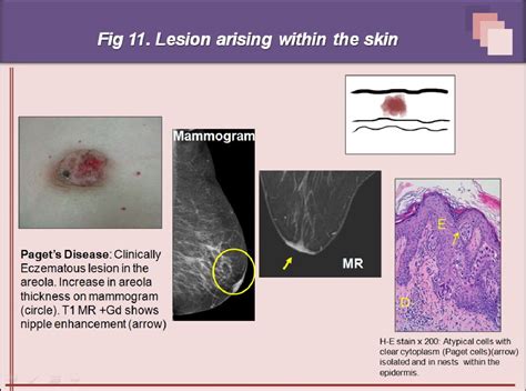 Figure 17 From Superficial Breast Lesions A Comprehensive Review Of