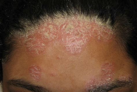 Itchy Rash On Forehead Causes Treatment And Prevention Tips