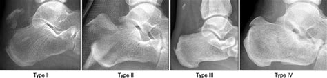 Classifi Cation Of Avulsion Fracture Of The Calcaneal Tuberosity Type