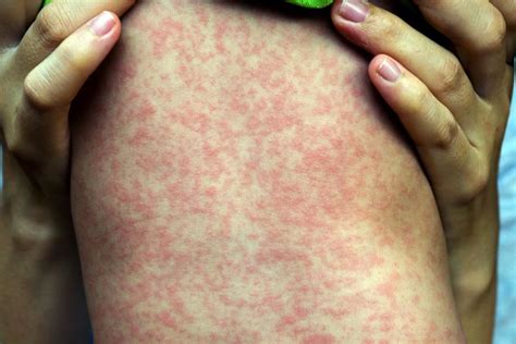 Viral Rashes In Babies Types Pictures Diagnosis Treat Vrogue Co