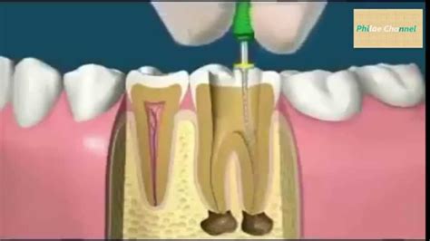 شاهد للفضوليين ماذا يفعل طبيب الاسنان What Does Dentist Do Youtube