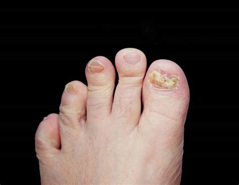 Royalty Free Broken Toe Nail Pictures Images And Stock Photos Istock