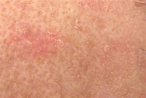 White Flaky Skin On Arms Toxoplasmosis