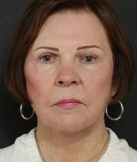 Brow Lift Before And After Gallery Face Toronto