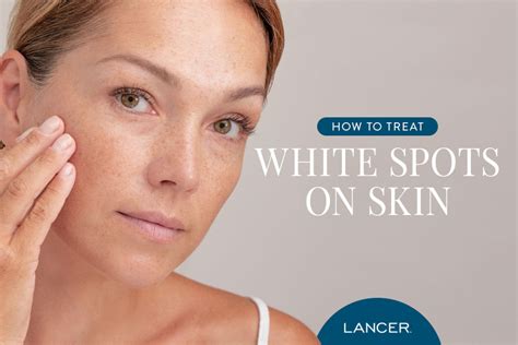 How To Treat White Spots On Skin Lancer Skincare Blog