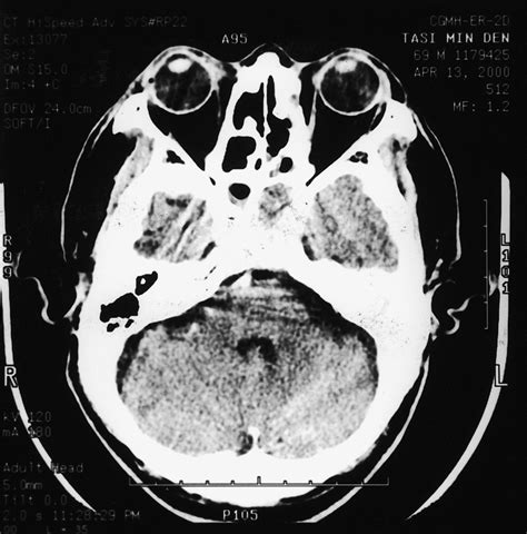 Axial Magnetic Resonance Scan With Gadolinium Showing Abnormal