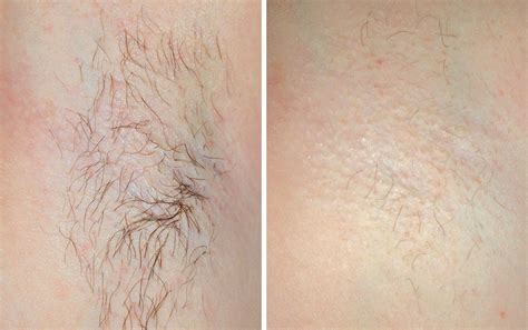 Laser Hair Removal Renew Medical Aesthetics Cheshire Clinic