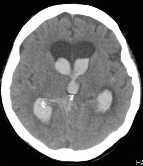 Intra Ventricular Hemorrhage New Jersey Brain And Spine