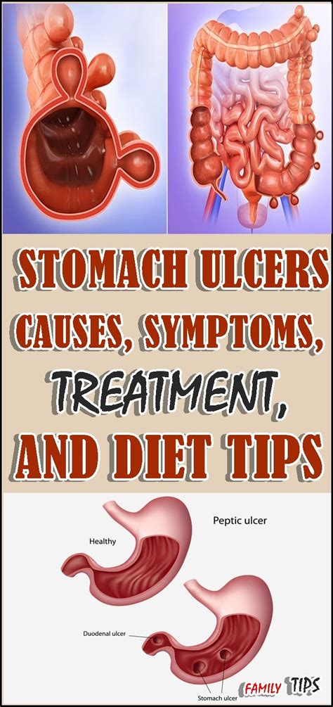 Best Ulcer Symptoms Images Ulcer Symptoms Ulcers Natural Treatments