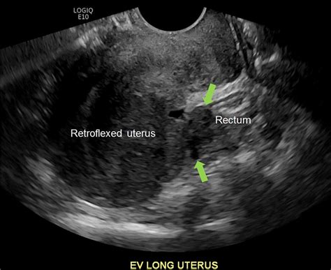 Anterior Fornix Transducer Position Imaging Through Cervix To
