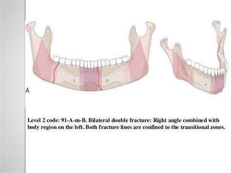 Classification Of Mandible Fracture