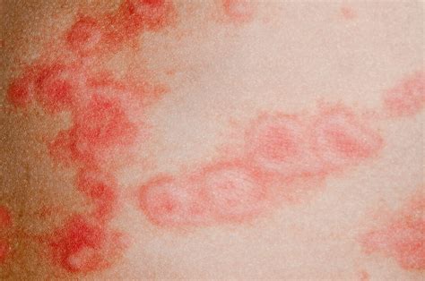 Urticaria Rash On The Skin Bild Kaufen 11626968 Science Photo Library
