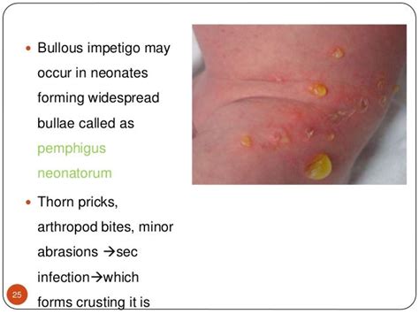 Streptococcal Infections As Related To Impetigo Pictures